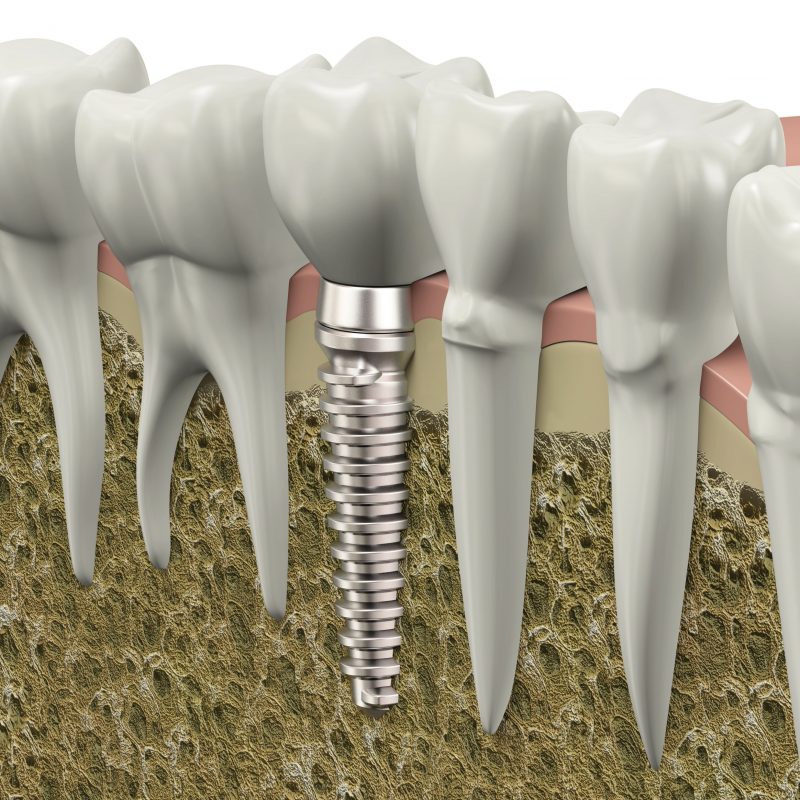 Dental Implants in Charlotte Make Eating Simpler for Patients